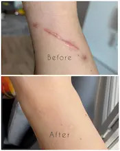 ژل ترمیم کننده جای زخم و جوش اُسکار